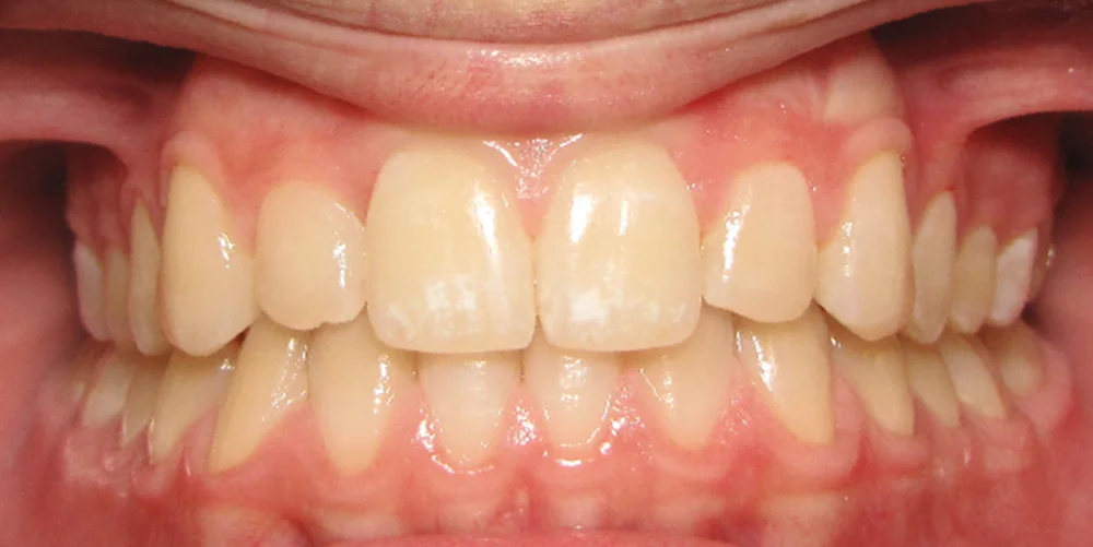 Patient After Invisalign Treatment