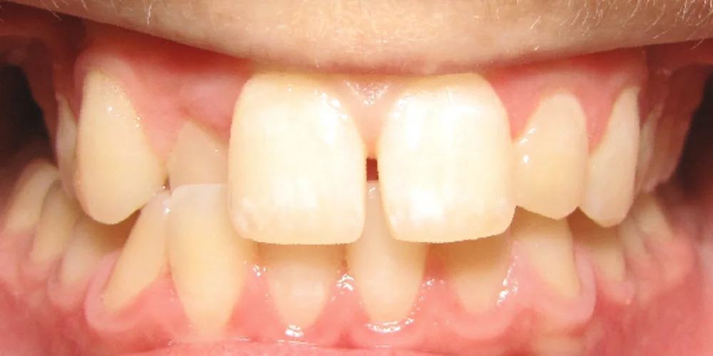 Patient Before Invisalign Treatment