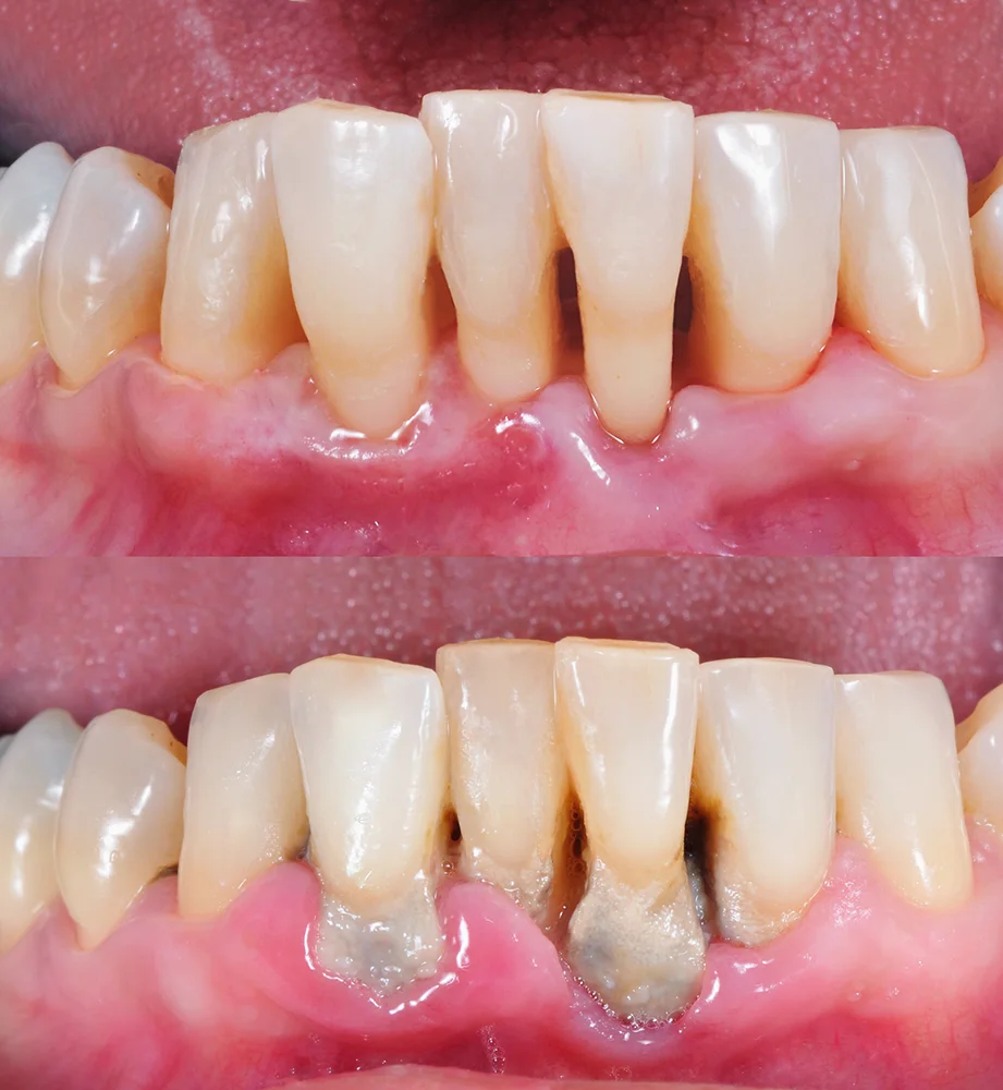 Patient Mouth Before & After Periodontal Disease Treatment