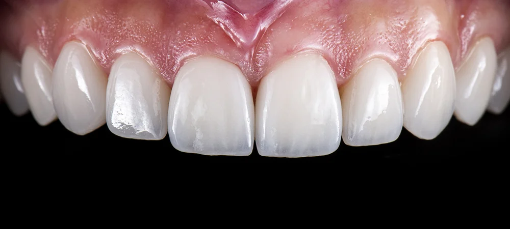 Porcelain Veneers Patient After Treatment