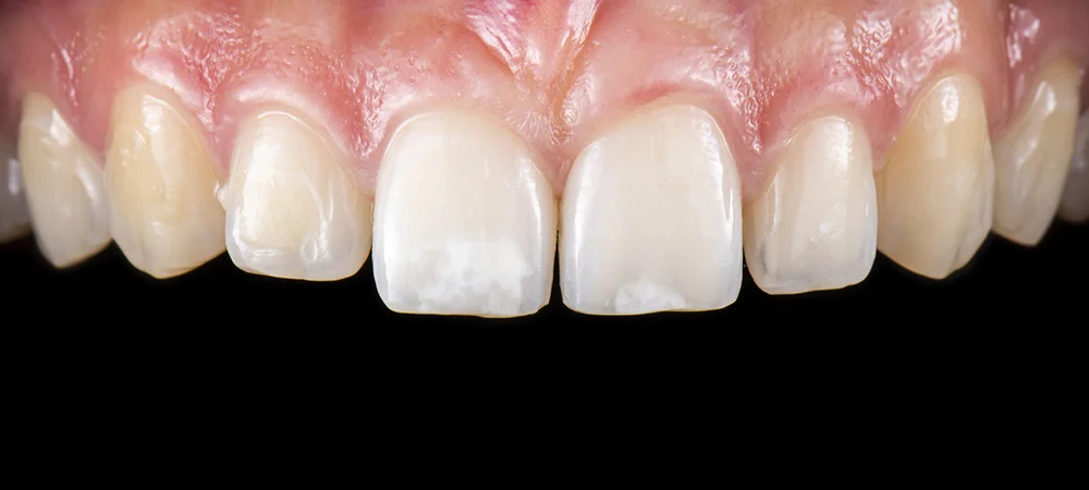 Porcelain Veneers Patient Before Treatment