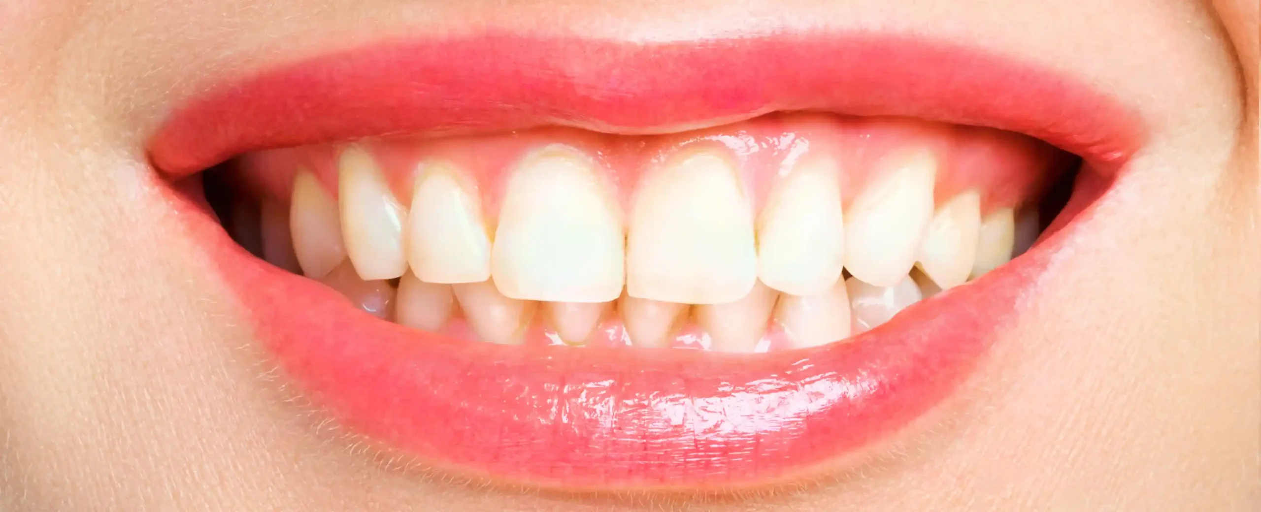 professional teeth whitening treatment