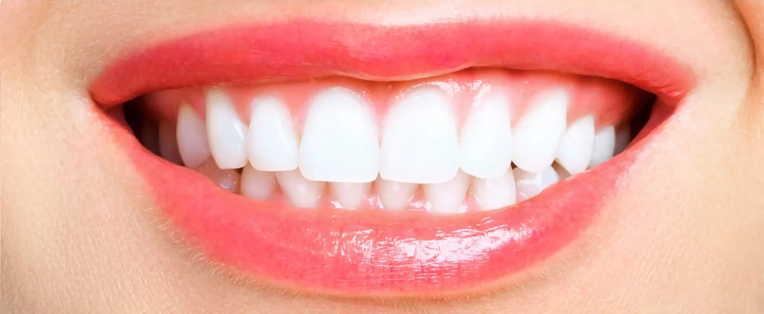 Perfect white teeth after whitening service