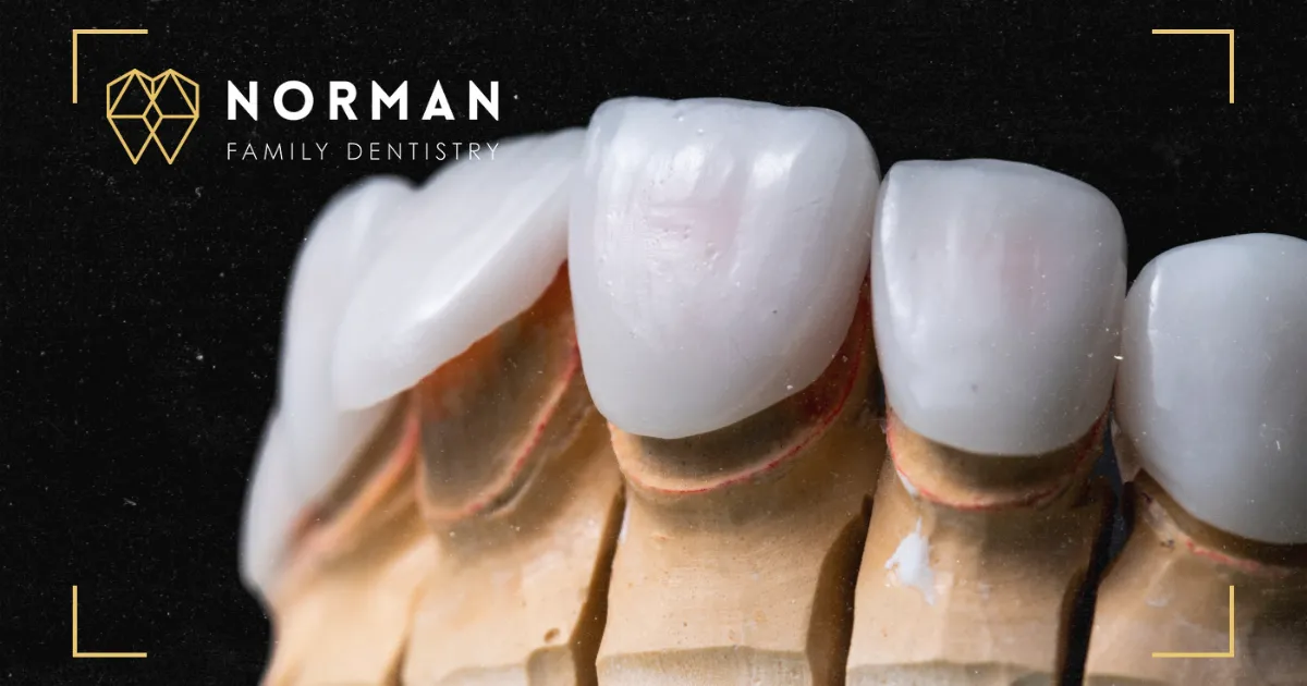 What Do Veneers Look Like After 10 Years?